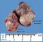 Pericardial teratoma