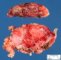 Thymic seminoma