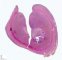 Digestive congenital fibrosarcoma