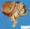 Ileocaecal digestive duplication cyst