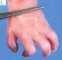 Hand oligodactyly