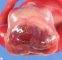 Anencephaly (fetus, 19 weeks)