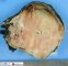Clear cell sarcoma of the kidney after formalin fixation