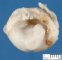 Juxta-splenic gastric duplication cyst