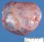 Pre-pancreatic mucinous cystadenoma