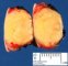 Cutaneous juvenile xanthogranuloma