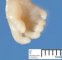 Posta-axial hexadactyly in a Meckel syndrome