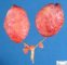 Bilateral non-obstructive renal dysplasia (BNORD) in Meckel (...)
