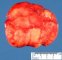 Mesenteric lipoma