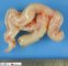 NF1-associated plexiform neurofibroma