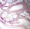 pleuropulmonary blastoma type 1