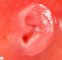 Preauricular appendix in a malformative syndrome (Fetus, 20 (...)