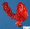Thyroid papillary carcinoma