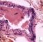 Zygomycosis (mucormycosis)