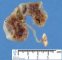 Renal adysplasia