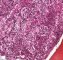 Bone marrow metastasis of a neuroblastoma
