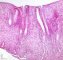 Colonic localization of an infantile myofibromatosis