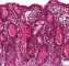 Intestinal cystic fibrosis