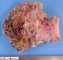 Hypodermal cystic lymphangioma