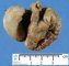Meconial plug upstream from an ileal atresia