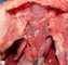 Bilateral diaphragmatic hernia in malformative syndrome