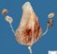 Prune belly sequence by urethral obstruction sequence with megacystis (Case (...)