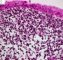 Botryoid embryonal rhabdomyosarcoma of the rhinopharynx