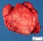 Cervical desmoid fibromatosis