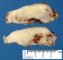 Cervical desmoid fibromatosis