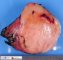 Clear cell sarcoma of the kidney
