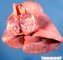 Nodal metastasis of an Ewing sarcoma at a pulmonary hilus