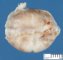 Juxta-splenic gastric duplication cyst