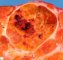 Macronodular cirrhosis and hepatocellular carcinoma in tyrosinemia