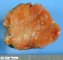 Hybrid tumor oncocytoma-chromophobe renal cell carcinoma
