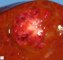 Hepatoblastoma in Beckwith-Wiedemann syndrome
