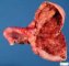 Ovarian luteal cyst