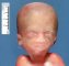 Macrocephaly (fetus, 20 weeks)