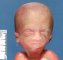 Micrognathia with retrognathia (fetus, 21 weeks)