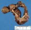 Intestinal invagination and perforative necrosis on Meckel diverticula