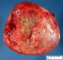 Necrotic uterine leiomyoma