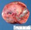 Ovarian endometriotic cyst
