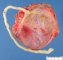 Placenta circumvallata with marginal insertion
