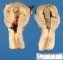 Uterine lumen appearance after endometrial ablation
