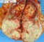 Renal epidermoid carcinoma