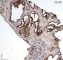 Retiform hemangioendothelioma