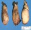Thyroid papillary carcinoma