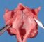 Laryngeal atresia