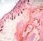 Cuteaneous tissue in immature ovarian teratoma (6 years)