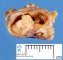 Parotidal cystic mucoepidermoid carcinoma