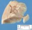 Quadrilobar left lung in trisomy 18 (20 weeks)